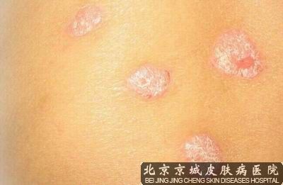 银屑病最新治疗进展，自然之旅与内心探寻的平和之路